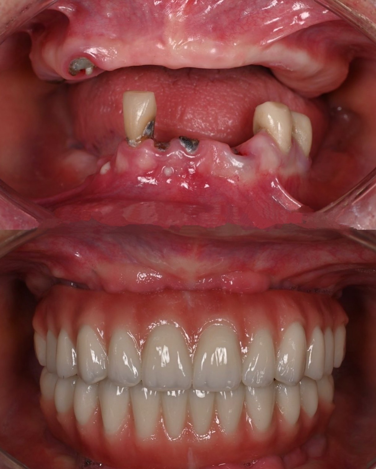 Antes e depois: implantes com prótese fixa completa