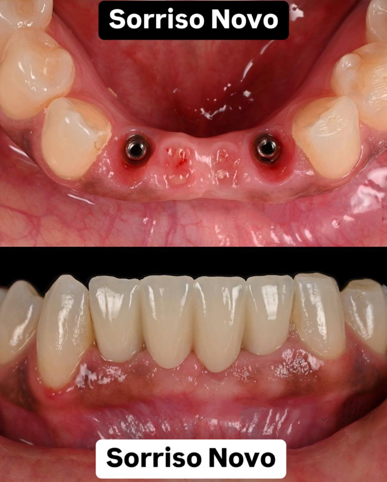 Antes e depois: prótese inferior fixa sobre implantes