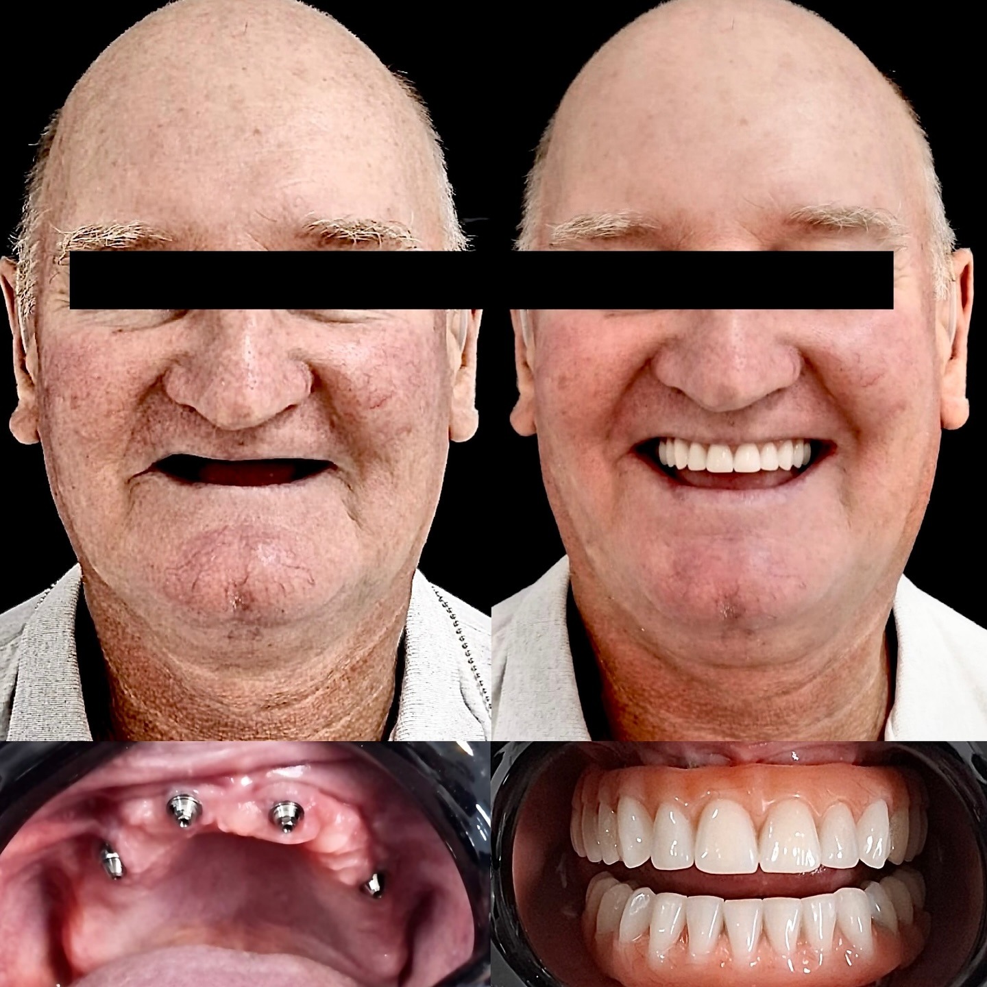 Antes e depois: reabilitação total de implantes dentários
