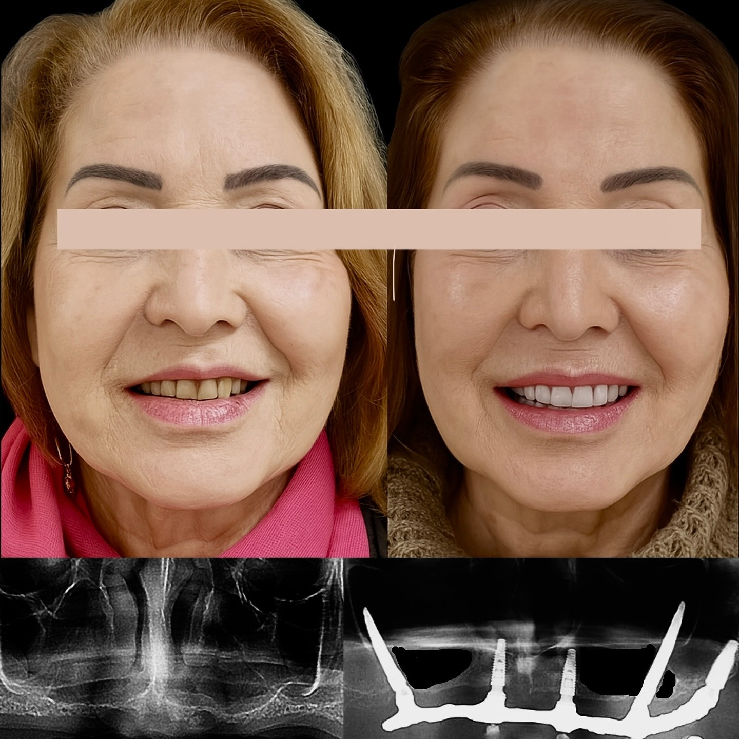 Antes e depois: reabilitação completa com implantes e prótese