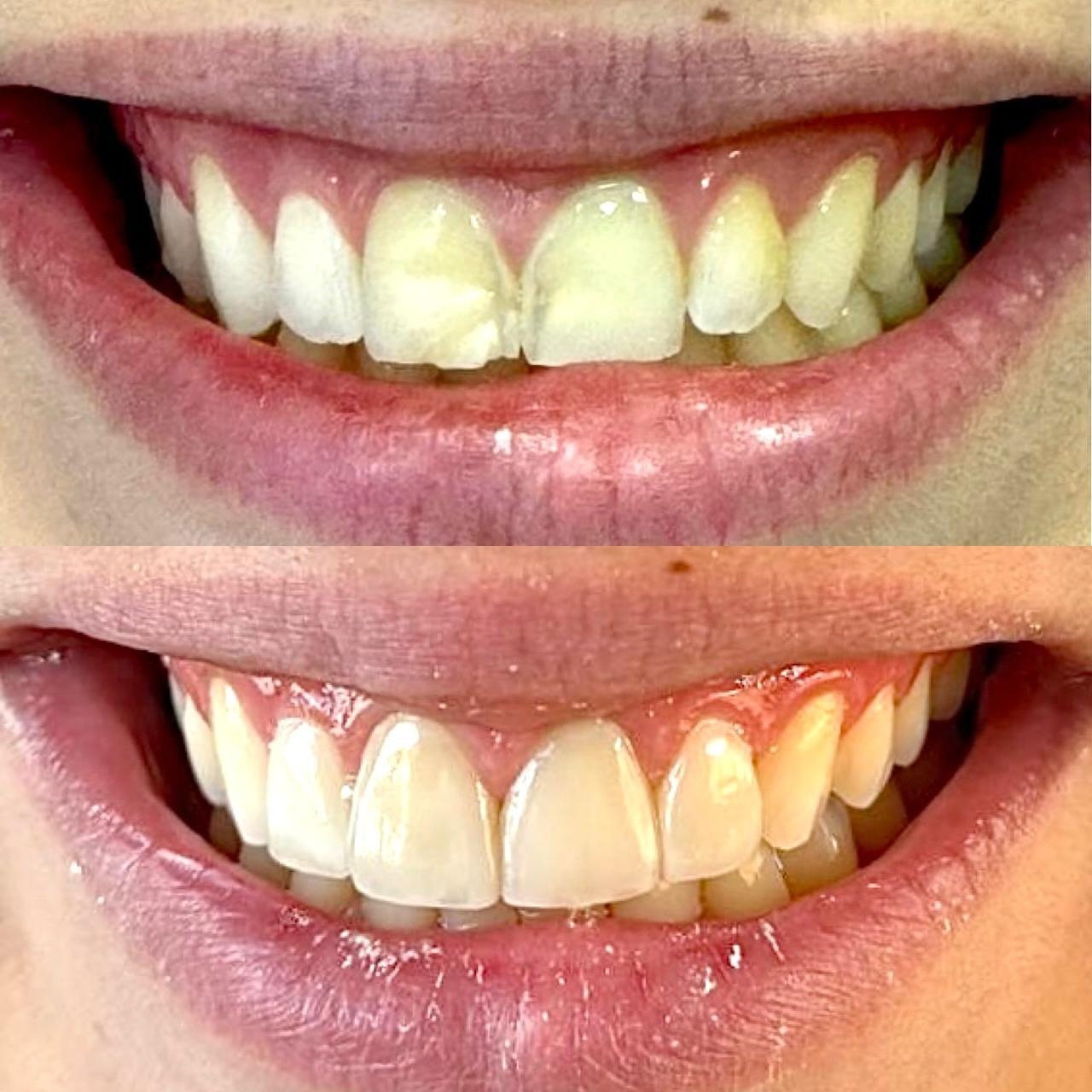 Antes e depois: clareamento e facetas no sorriso