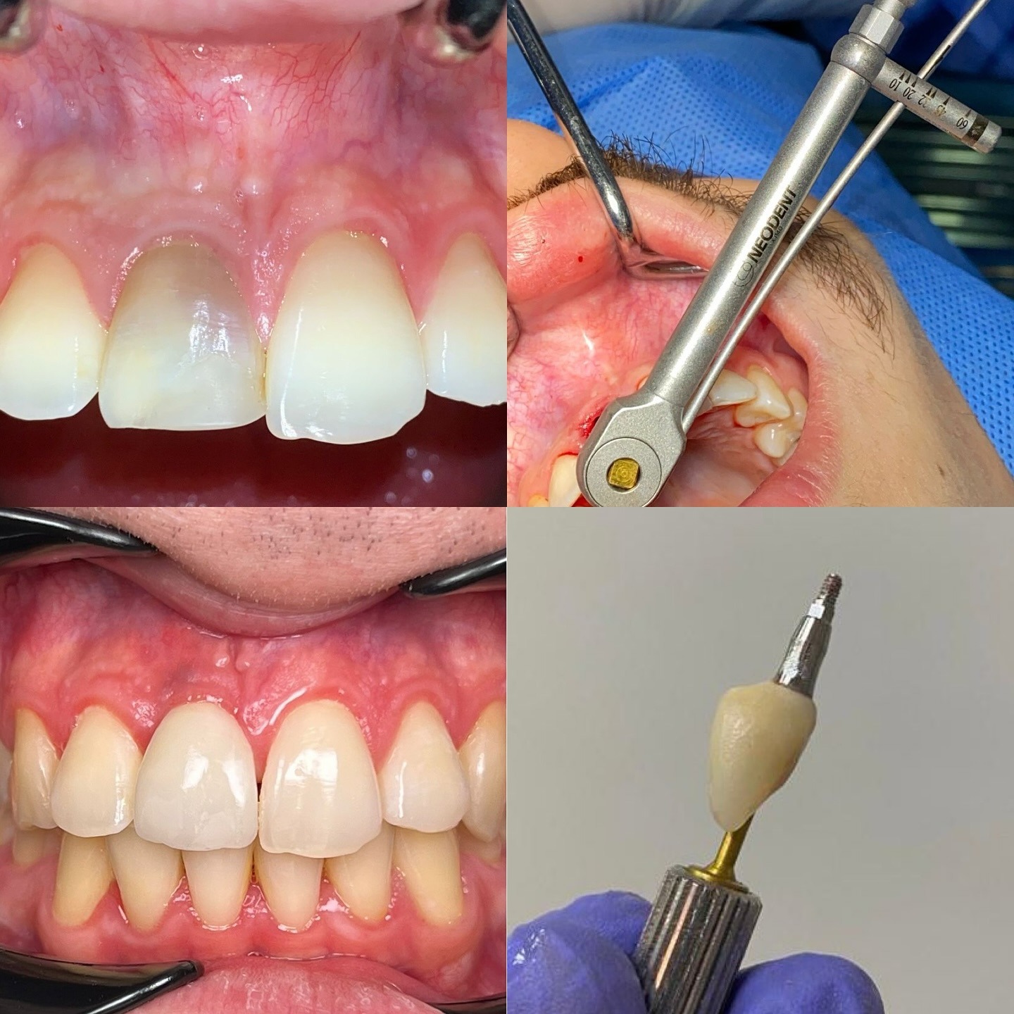 Antes e depois: implante unitário com coroa em resina